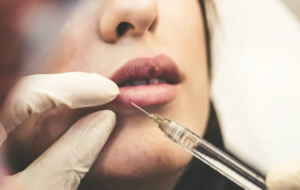 What to Know Before Booking Botox in London for the First Time